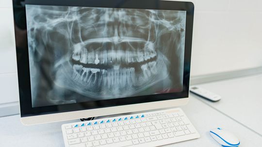 Digitales Zahnröntgen